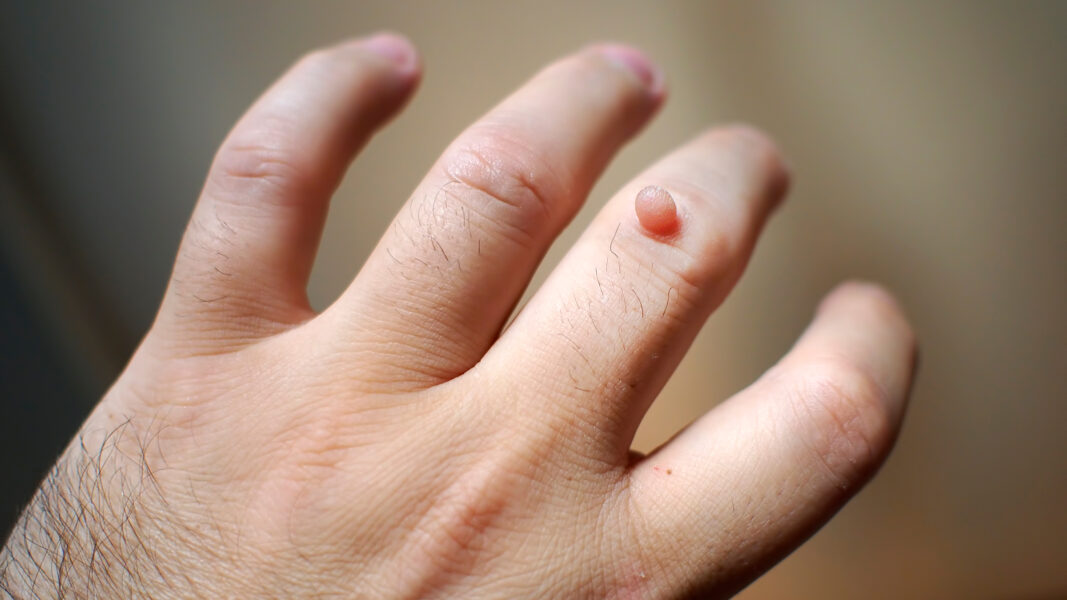closeup_wart_on_finger_503048090