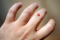 closeup_wart_on_finger_503048090
