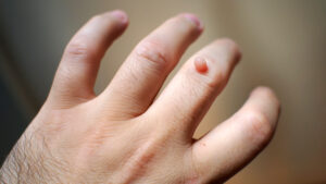 closeup_wart_on_finger_503048090